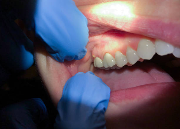 Best Emergency Dental Care for Broken or Chipped Teeth in Wilmington Manor, DE